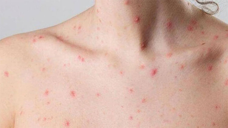 Viruela del Mono: detectan el primer caso de una variante m&aacute;s contagiosa y severa en Argentina